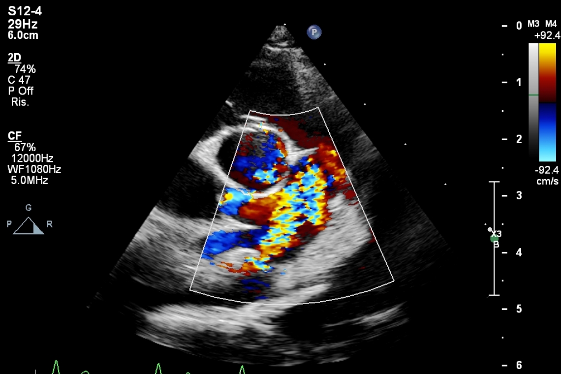 IL DOTTO ARTERIOSO PERVIO (PDA)